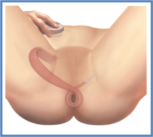 Graciloplastia- tratamiento incontinencia fecal